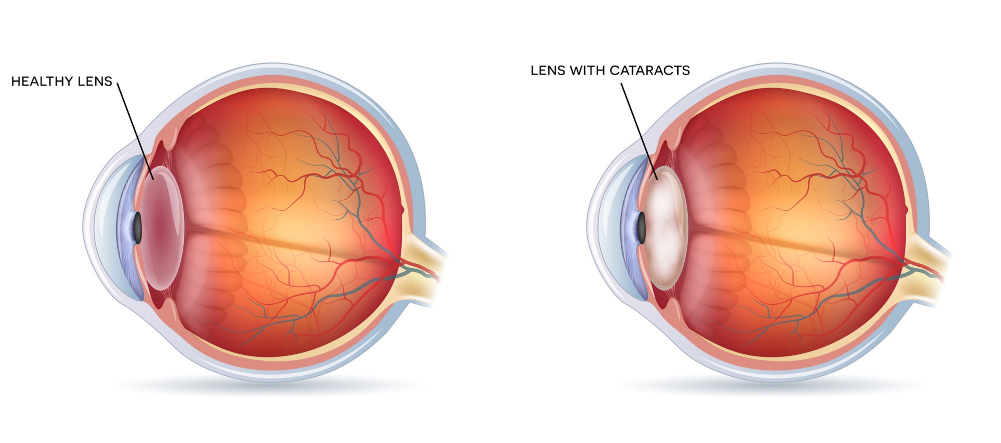 Cataracts. Human vision disorder, detailed anatomy of cataracts and healthy eye.