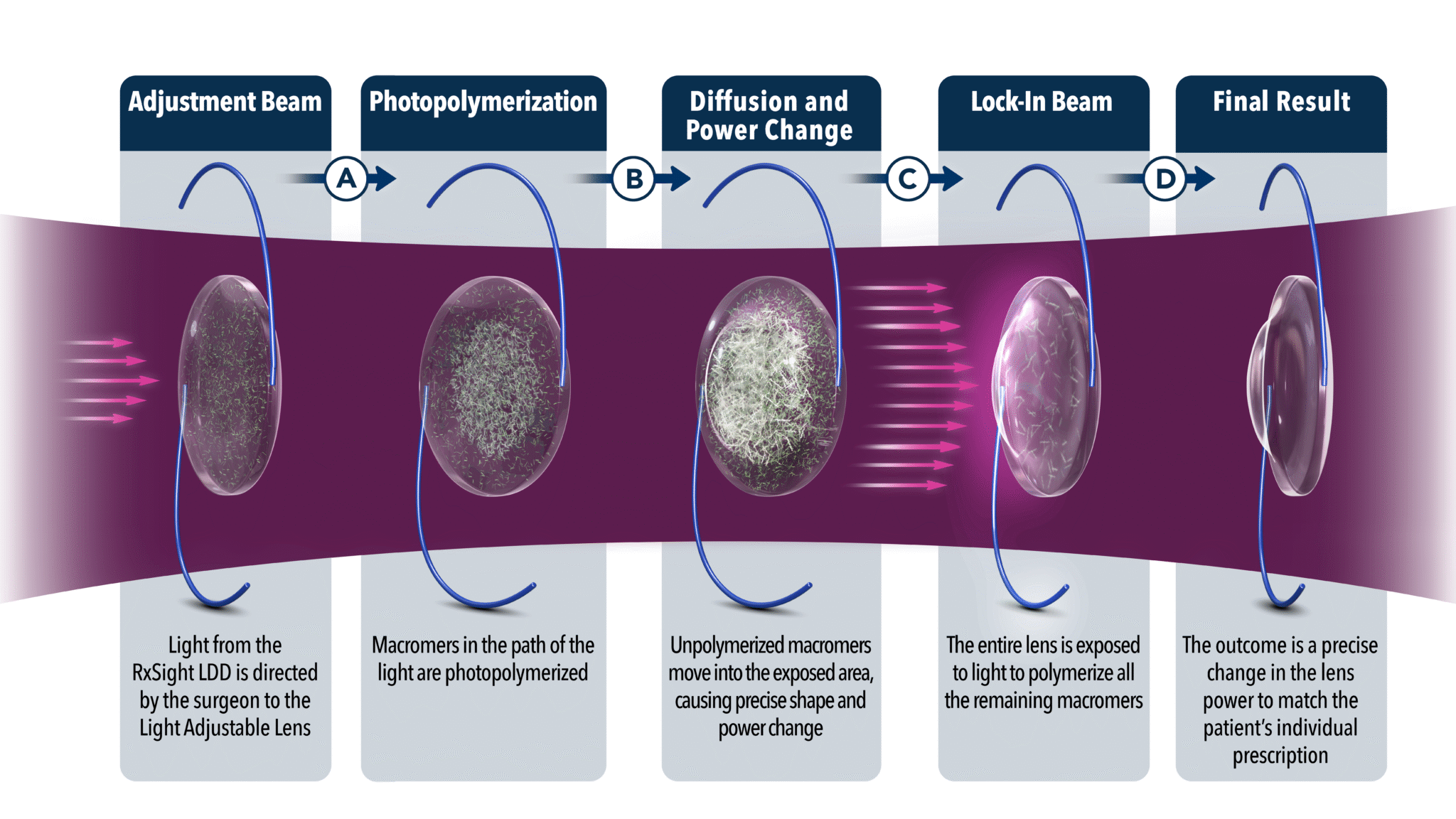 Diagram showing how light adjusts an intraocular lens: light exposure polymerizes macromers, redistributes material to change lens power, locks it in, and produces a customized prescription.